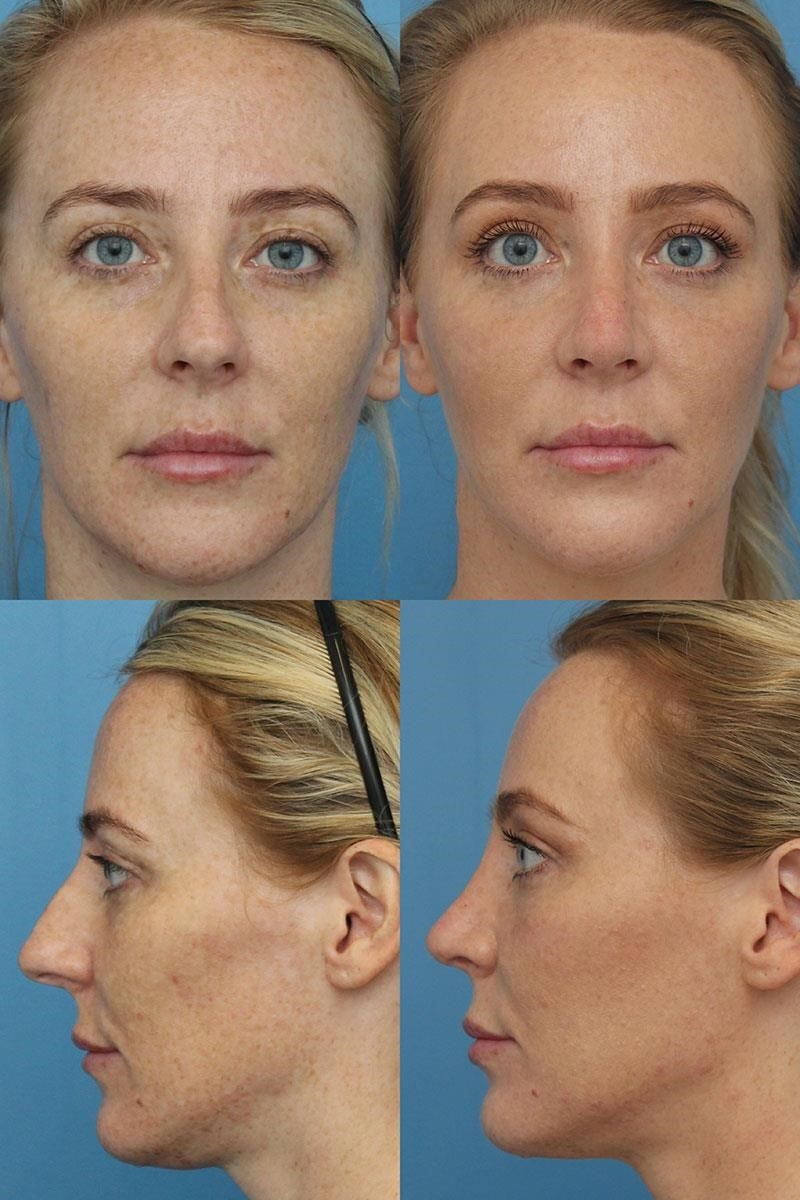 closed rhinoplasty